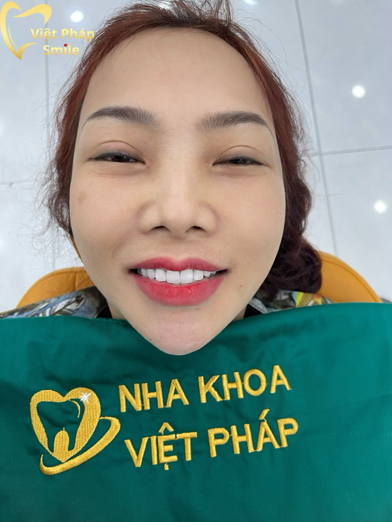 Chị N.T.Hoa làm 18 răng sứ zirconia tại nha khoa Việt Pháp Smile