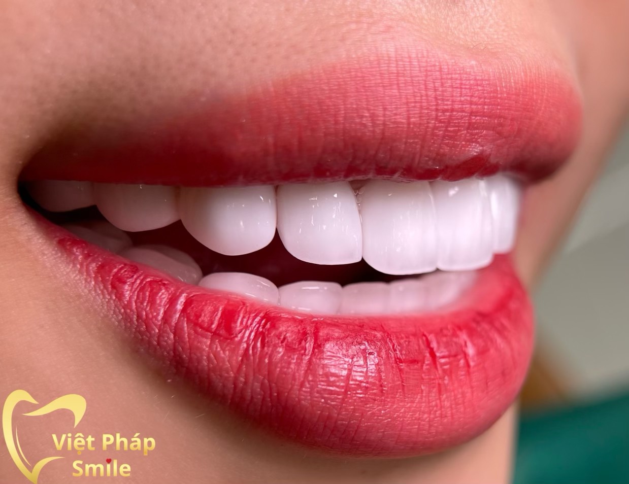 Trả Góp 0% Lãi suất trên toàn HỆ THỐNG NHA KHOA QUỐC TẾ VIỆT PHÁP Smile